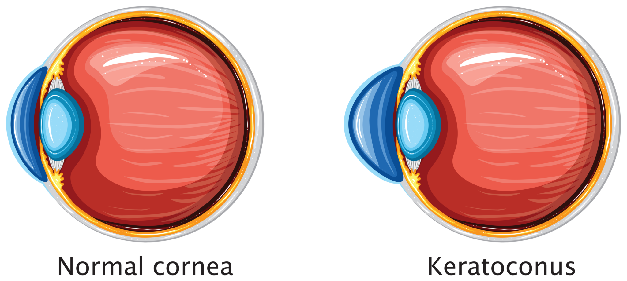 Cornea Beverly Hills | Cornea Cross-Linking Orange County | Gaster Eye